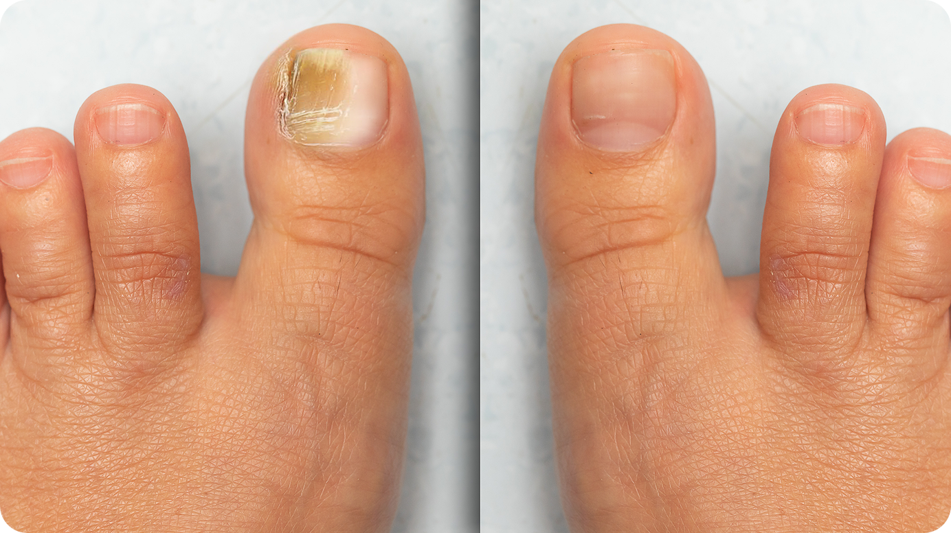 Before After Toes